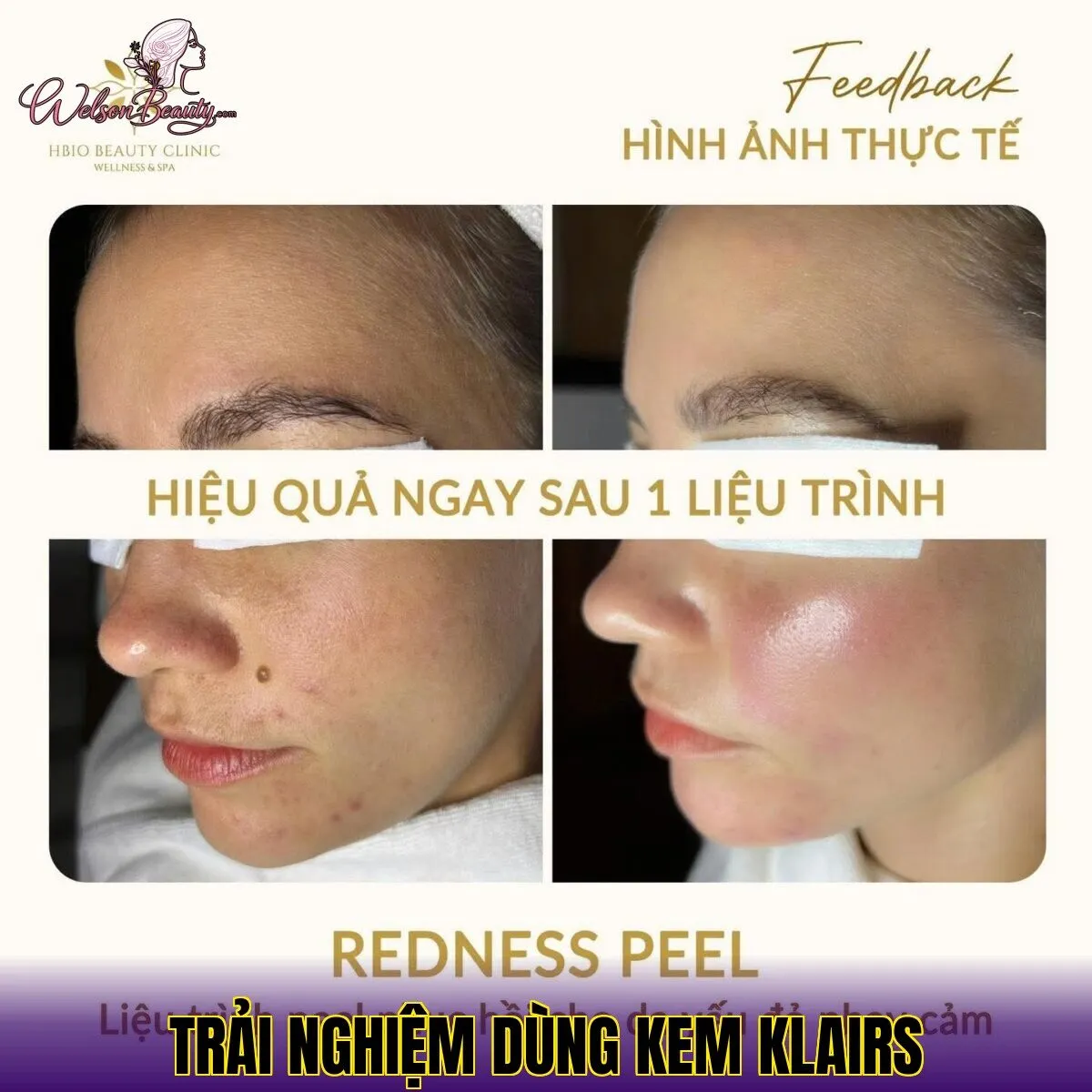 trải nghiệm dùng kem klairs