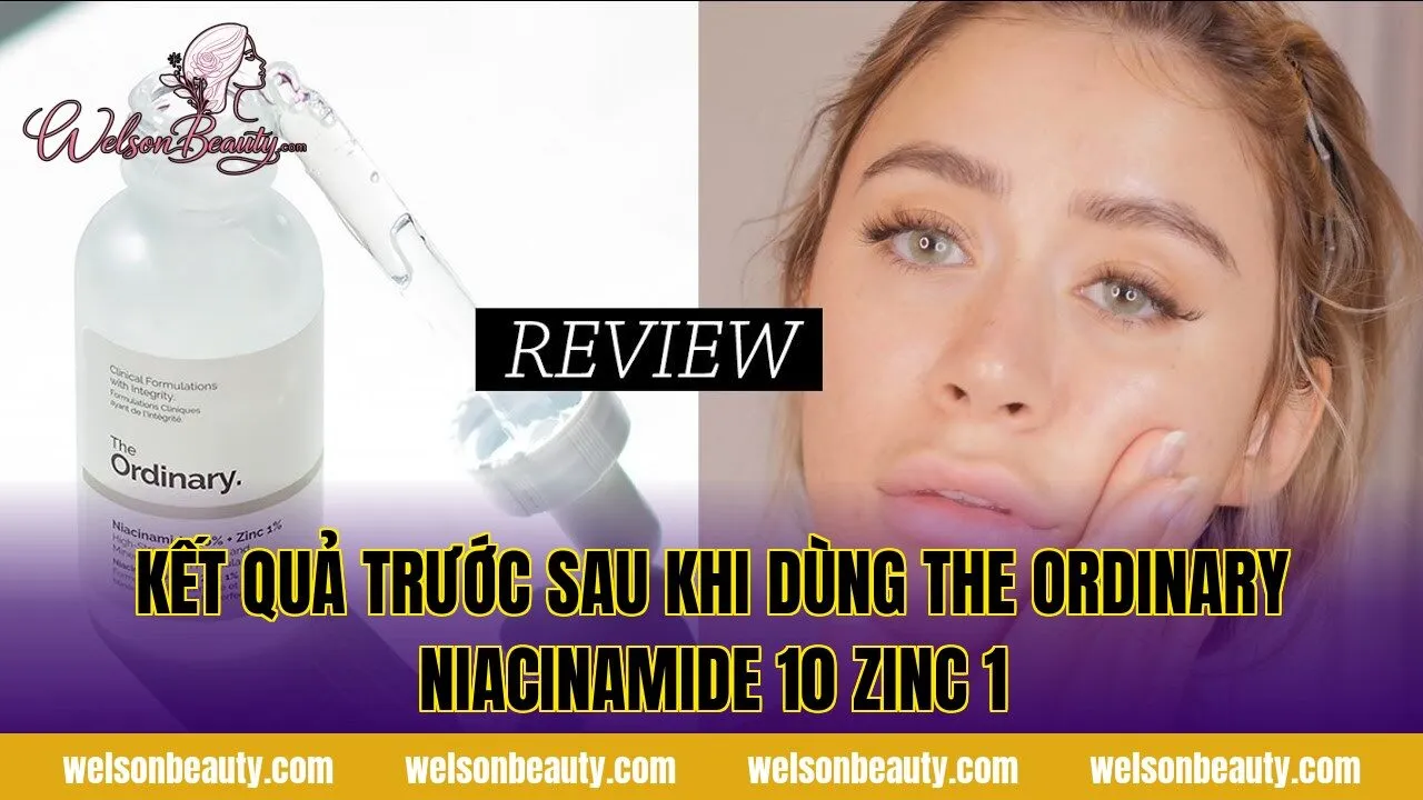 kết quả trước sau khi dùng the ordinary niacinamide 10 zinc 1