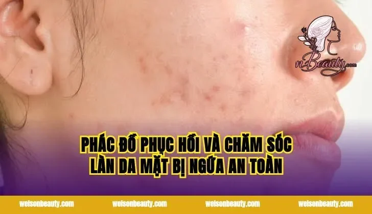 Phác đồ phục hồi và chăm sóc làn da mặt bị ngứa an toàn